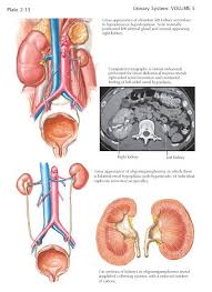 Renal Hypoplasia A Normal Kidney Contains Approximately 600 000 To 1 400 000 Nephrons Renal Hypoplasia Occurs When A Ki In 2020 Renal Renal Transplant Renal Disease