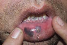 Check spelling or type a new query. Diagnosis Of Oral Pigmentations And Malignant Transformations Sciencedirect