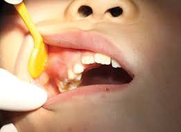 From the story red by redrosefreeheart with 4,457 reads. Primary Maxillary Right First Molar Tooth A Was Seriously Carious And Download Scientific Diagram