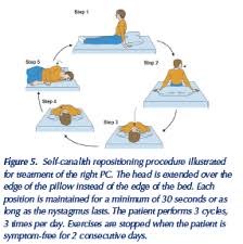 Image result for Canalith Repositioning Procedure