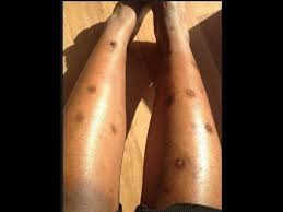 How To Get Rid Of Dark Spots On Legs Amp Body Fast Get Clear Even Skin Tone All Over Youtube Dark Spots On Skin Dark Spots On Legs Lighten Dark Spots