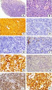 The name often refers to just the cancerous. Cyclin D1 Large B Cell Lymphoma With Altered Ccnd1 And Bcl 6 Rearrangements A Diagnostic Challenge Biomarker Research Full Text