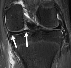 Posterior Horn Medial Meniscus Tear Knee Specialist Minnesota