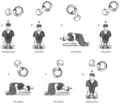 Image result for Canalith Repositioning Procedure