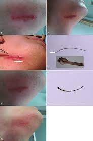 This may help heal the ingrown hair and prevent infection. The Presentations Of Ingrowing Hair A 4 3 Cm Long Black Linear Lesion Download Scientific Diagram