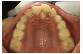 Maybe you would like to learn more about one of these? Mesiodens A Case Report And Literature Review