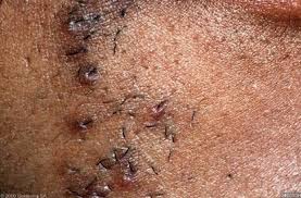 So older, untreated warts are the most likely to sprout hair. Ingrown Hair Difference Between Ingrown Hair And Genital Warts