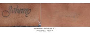 How long does it take to remove a tattoo? Picoclear Tattoo Removal Dr Shadan Kabiri