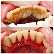 It's because the price will depend on services acquired. Teeth Cleaning Dental Checkup In Nyc Cost Service Information