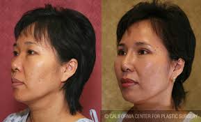 Her nose bridge looks a lot thinner now and the tip is more pointy too. Patient 6368 Asian Rhinoplasty Before And After Photos Encino Plastic Surgery Gallery Glendale Dr Sean Younai