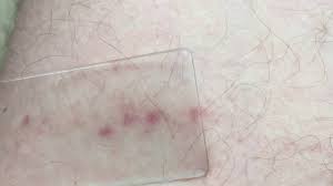 Both of these types of infections are very serious and can be deadly in a matter of hours. Glass Test Meningitis Rash Youtube