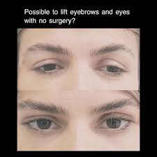 EYEBROW LIFT CONCERNS - Vista Clinic Melbourne