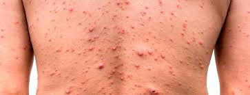 Image result for skin rash acute hiv infection