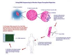 Image result for Transplant Rejection