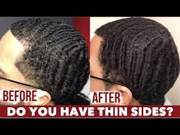 Here, a guide to the five most common causes of hair loss in men and how to treat them. Hair Loss Causes For Men How To Stop Hair Loss Naturally Thicken Thinning Hair Youtube