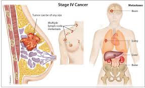 The most common symptoms of stage 4 metastatic cancer are weight loss and poor appetite. Metastatic Breast Cancer Dr Ramawad Soobrah Breast Surgeon Tel 52525210