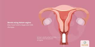 (pasti dia mikir, ngapain nih, cewek cantik kok mau mengintip kemaluan gue?) Benda Asing Dalam Vagina Tanda Dan Gejala Penyebab Cara Mengobati Cara Mencegah