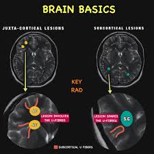 Image result for Brain Lesion