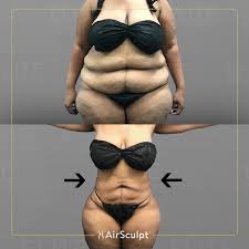 Image result for Liposuction