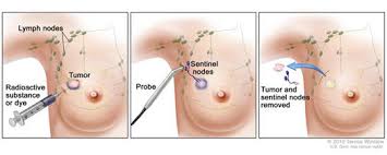 23.07.2019 · prostate cancer symptoms in telugu. Sentinel Lymph Node Biopsy National Cancer Institute