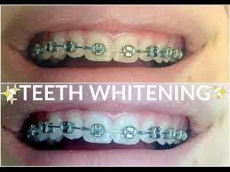 Firstly, there are two types of whitening, extrinsic and intrinsic to use this remedy, mix one teaspoon of baking soda with two teaspoons of water and brush your teeth with the paste a few times per week. Pin On Teeth Health