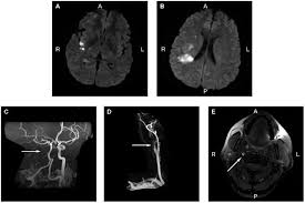 Pain can occur in the right side of the neck. Dissections Of Brain Supplying Arteries Nature Reviews Neurology