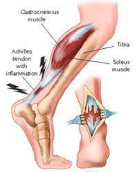 Fysiotherapie4all Achillespees Scheur Complete Ruptuur