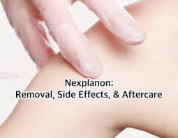 When given a choice of all birth control options, 75 percent of women choose iuds and implants. Nexplanon Removal Side Effects Aftercare Embry Women S Health