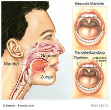 Angina Mandelentzundung Ihre Apotheke Informiert