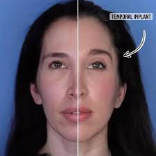 More and more of my patients are coming to me asking what they can do about  their temporal hollowing., Rather than filling her temples with a few  syringes of filler, I performed a procedure giving her ...