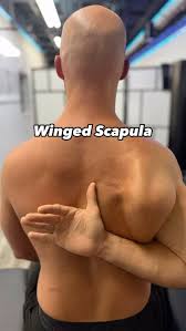 Image result for Winged Scapula