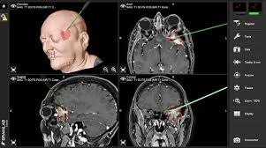 What causes a cerebral aneurysm? Cranio Araujo E Fazzito Neurocirurgia E Neurologia Em Sao Paulo Araujo E Fazzito Neurocirurgia E Neurologia Em Sao Paulo
