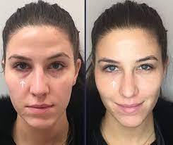 While filler in the checks may only last six months, hyaluronic acid filler under your eyes can last up to a year. Under Eye Fillers For Dark Circles Efficacy Photos Cost Side Effects Under Eye Fillers Dark Eye Circles Dark Under Eye