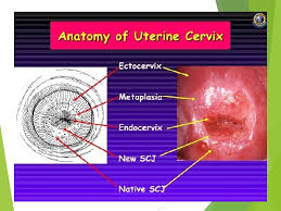 Die epithelentwicklung der cervix and portio vaginalis uteri und die pseudoerosio congenita, arch. Premalignant Disease Of The Cervix Dr Dina Akeel