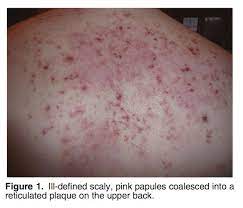 Doxycycline Archives The Keto Rash Keto Rash Skin Care Acne Body Acne