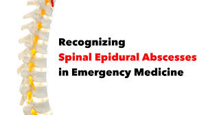 Image result for Spinal Epidural Abscess