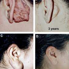 Pdf Management Of Keloids And Hypertrophic Scars Current And Emerging Options