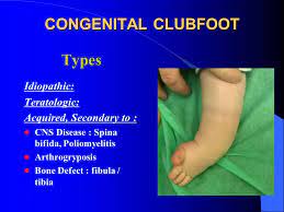 Clubfoot is a fairly common birth defect and is usually an isolated problem for an otherwise healthy newborn. Congenital Clubfoot Congenital Talipes Equino Varus Ppt Video Online Download