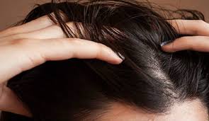 Ask any woman what is the number one hair issue she faces, and hair fall will be the most common answer. Treat Your Hair With Kalonji Oil For Preventing Hair Loss