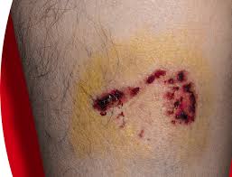 Image result for Rabies