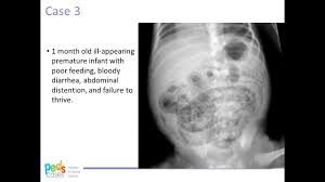 Image result for Abdominal XRay
