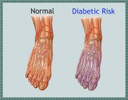 Diabetic neuropathy is a condition that happens in the more advanced stages of diabetes. Pioneer Podiatry Diabetes And Foot Care