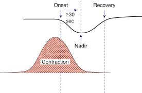 Image result for Late Deceleration