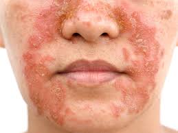 Image result for dermatitis contacta