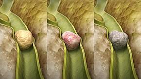 gallbladder structure à¤¸à¤¾à¤ à¥? à¤?à¤®à¥?à¤? à¤ªà¤°à¤¿à¤£à¤¾à¤®