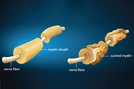Ms means there is damage to the protective sheath (known as myelin) that surrounds the nerve fibres in the brain and spinal cord. Study Brain Stem Cells Age Faster In Ms Patients Uconn Today