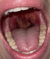 Image result for Uvulitis