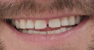 Why do my teeth shift after they've been straightened. 4 Methods To Close Gaps Between Teeth Trusted Dental Gold Coast