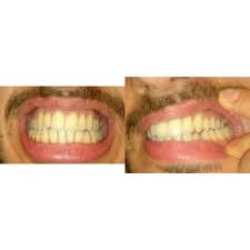 In addition to using invisalign bite correction, fixing a crossbite might require the use of an additional orthodontic appliance like a palatal expander. Can Invisalign Fix My Crossbite Or It S Waste Of Time Photos
