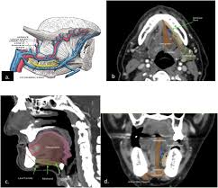 Out of the various types of cancer, one is bone cancer which affects the. Operative Tactics In Floor Of Mouth And Tongue Cancer Resection The Importance Of Imaging And Planning British Journal Of Oral And Maxillofacial Surgery